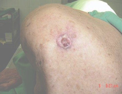 carcinoma_cutaneo_cancer/piel_basocelular_preoperatorio carcinoma_cutaneo_cancer/piel_basocelular_preoperatorio