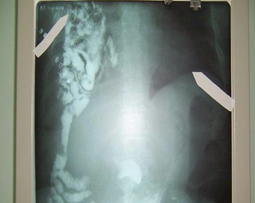 hernia_diafragmatica_traumatica/transito_intestinal_torax