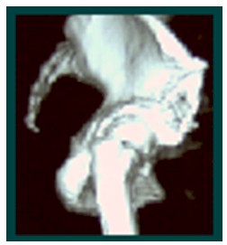 TAC_3D_displasia_acetabular/3DTC_TAC3D_osteotomia TAC_3D_displasia_acetabular/3DTC_TAC3D_osteotomia