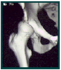 TAC_3D_displasia_acetabular/TC3D_TAC3D_cadera TAC_3D_displasia_acetabular/TC3D_TAC3D_cadera