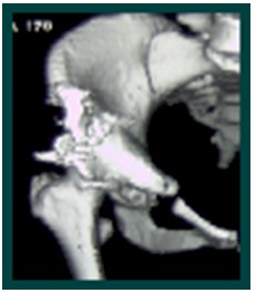 TAC_3D_displasia_acetabular/TC3D_TAC3D_osteotomia TAC_3D_displasia_acetabular/TC3D_TAC3D_osteotomia