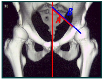 TAC_3D_displasia_acetabular/acetabulo_medial_desocupado