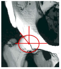 TAC_3D_displasia_acetabular/angulo_borde_anterior