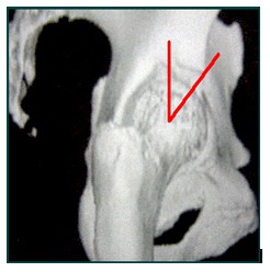 TAC_3D_displasia_acetabular/angulo_centro_anterior