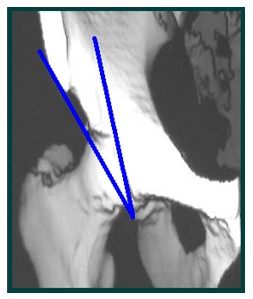 TAC_3D_displasia_acetabular/anteversion_acetabulo TAC_3D_displasia_acetabular/anteversion_acetabulo