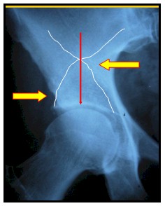 TAC_3D_displasia_acetabular/arco_gotico_arena