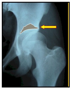 TAC_3D_displasia_acetabular/ceja_de_Pawels