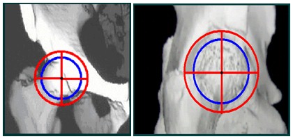 TAC_3D_displasia_acetabular/centro_rotacion_cadera