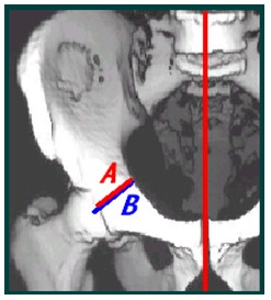 TAC_3D_displasia_acetabular/deficit_pared_anterior