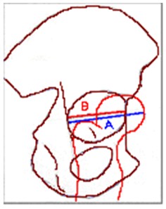 TAC_3D_displasia_acetabular/extrusion_anterior_cabeza