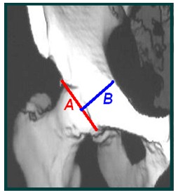 TAC_3D_displasia_acetabular/profundidad_acetabulo