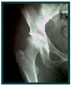 TAC_3D_displasia_acetabular/radiografia_simple_cadera