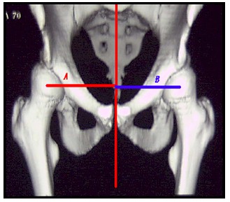 TAC_3D_displasia_acetabular/simetria_centro_rotacion