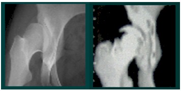 TAC_3D_displasia_acetabular/sin_tratamiento_previo TAC_3D_displasia_acetabular/sin_tratamiento_previo