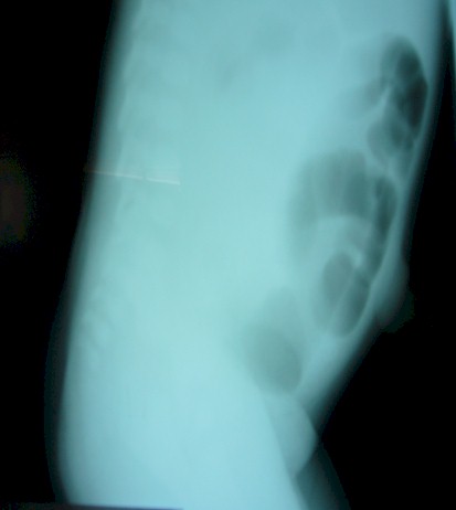 caso_atresia_intestinal/radiografia_lateral_abdomen