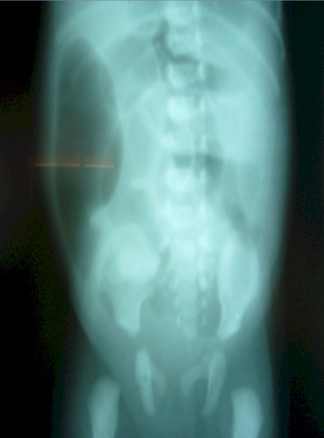 caso_atresia_intestinal/radiografia_simple_abdomen