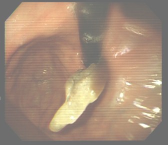 cuerpo_esofago_esofagico/extraccion_videoendoscopia_endoscopia