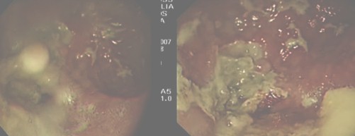 diverticulo_epifrenico_doble/endoscopia_saco_diverticular