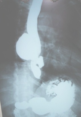 diverticulo_epifrenico_doble/esofagograma_diverticulos_contraste diverticulo_epifrenico_doble/esofagograma_diverticulos_contraste