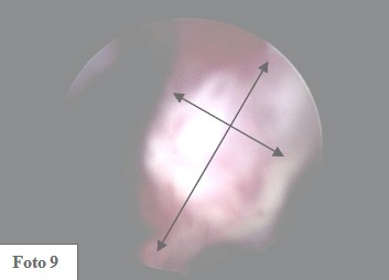 embarazo_ectopico_cervical/area_trofoblastica_polipoide