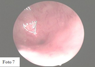 embarazo_ectopico_cervical/cavidad_uterina_vacia