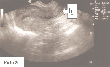 embarazo_ectopico_cervical/contenido_hematico_endometrial
