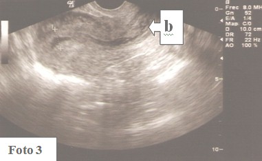 embarazo_ectopico_cervical/contenido_hematico_endometrial embarazo_ectopico_cervical/contenido_hematico_endometrial