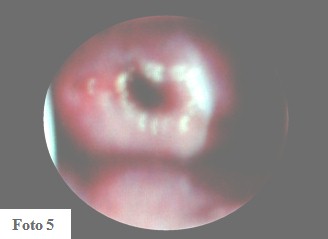 embarazo_ectopico_cervical/cuello_uterino_histeroscopia