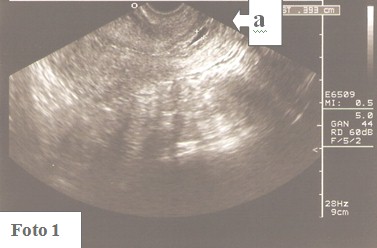 embarazo_ectopico_cervical/ecografia_OCI_saco embarazo_ectopico_cervical/ecografia_OCI_saco