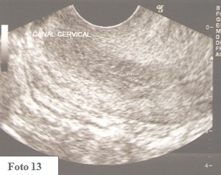 embarazo_ectopico_cervical/ecografia_endometrio_endocervix embarazo_ectopico_cervical/ecografia_endometrio_endocervix