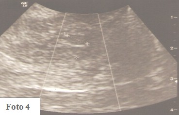 embarazo_ectopico_cervical/ecografia_no_vascularizacion