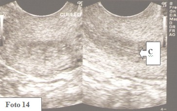 embarazo_ectopico_cervical/ecografia_normal_endometrio