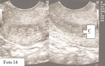 embarazo_ectopico_cervical/ecografia_normal_endometrio embarazo_ectopico_cervical/ecografia_normal_endometrio