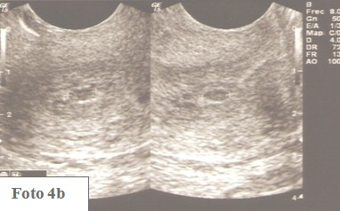 embarazo_ectopico_cervical/ecografia_ultrasonido_vascularizacion