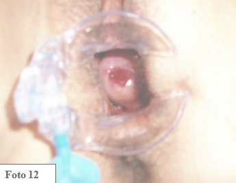 embarazo_ectopico_cervical/especuloscopia_cervix_OCE embarazo_ectopico_cervical/especuloscopia_cervix_OCE