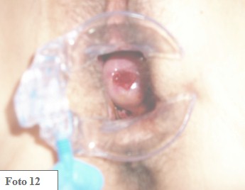 embarazo_ectopico_cervical/especuloscopia_cervix_OCE