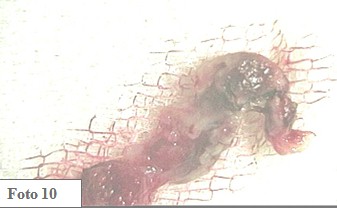 embarazo_ectopico_cervical/feto_trofoblastico_endocervix embarazo_ectopico_cervical/feto_trofoblastico_endocervix