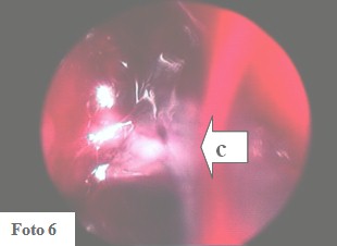 embarazo_ectopico_cervical/imagen_vegentante_endocervix