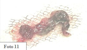 embarazo_ectopico_cervical/material_reseccion_embrion