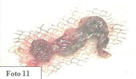 embarazo_ectopico_cervical/material_reseccion_embrion embarazo_ectopico_cervical/material_reseccion_embrion