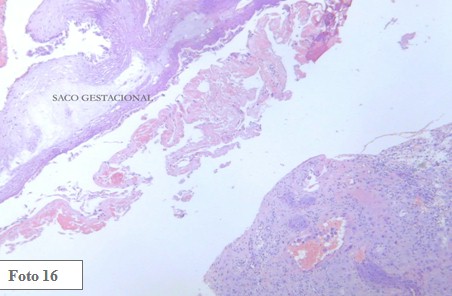 embarazo_ectopico_cervical/metotrexato_metotrexate_endocervix embarazo_ectopico_cervical/metotrexato_metotrexate_endocervix