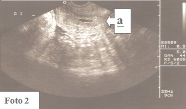 embarazo_ectopico_cervical/saco_irregular_ecografia