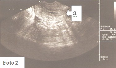embarazo_ectopico_cervical/saco_irregular_ecografia embarazo_ectopico_cervical/saco_irregular_ecografia