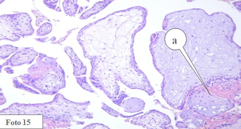 embarazo_ectopico_cervical/vellosidades_coriales_gestacion