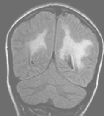 encefalomielitis_diseminada_aguda/ADEM_RMN_FLAIR