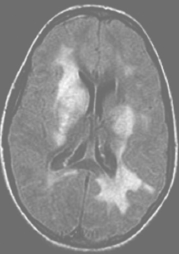 encefalomielitis_diseminada_aguda/RMN_ADEM_lesiones