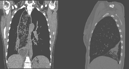 manejo_acalasia_avanzada/dilatacion_esofago_inflamacion