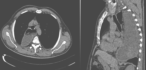 manejo_acalasia_avanzada/tomografia_dilatacion_esofago