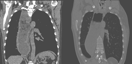 manejo_acalasia_avanzada/tomografia_multicorte_esofago