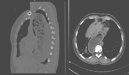 manejo_acalasia_avanzada/tomografia_toracica_multicorte